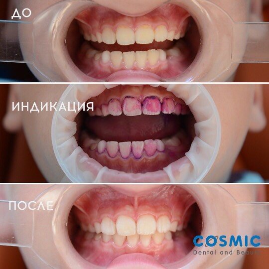 Кейс 2. Пациент мальчик, 9 лет. Аналогично фото до/фото с индикацией налета/фото после процедуры.