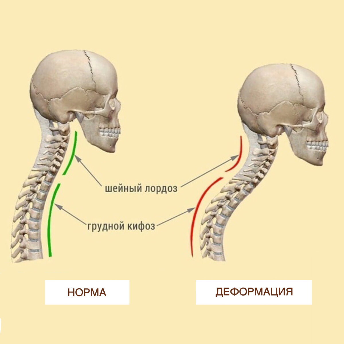 Почему шея вперед. Лордоз шейного отдела позвоночника. Кифоз и лордоз шейного отдела. Выпрямленный лордоз шейного отдела позвоночника. Гиперлордоз шейного отдела.