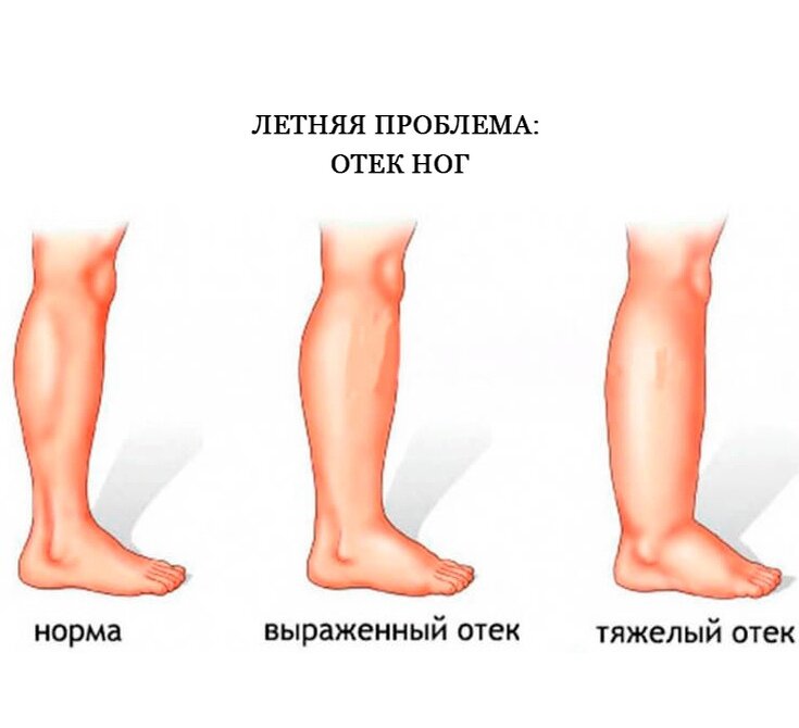 Как определить отек?