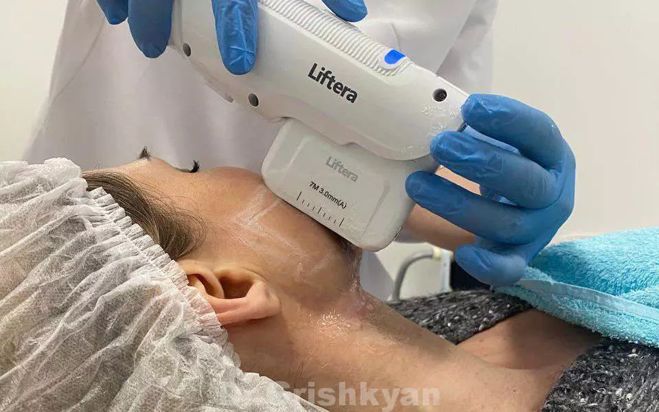 SMAS-лифтинг на аппарате Лифтера. Фото предоставлено Д.Р. Гришкяном. Имеются противопоказания, требуется консультация специалиста