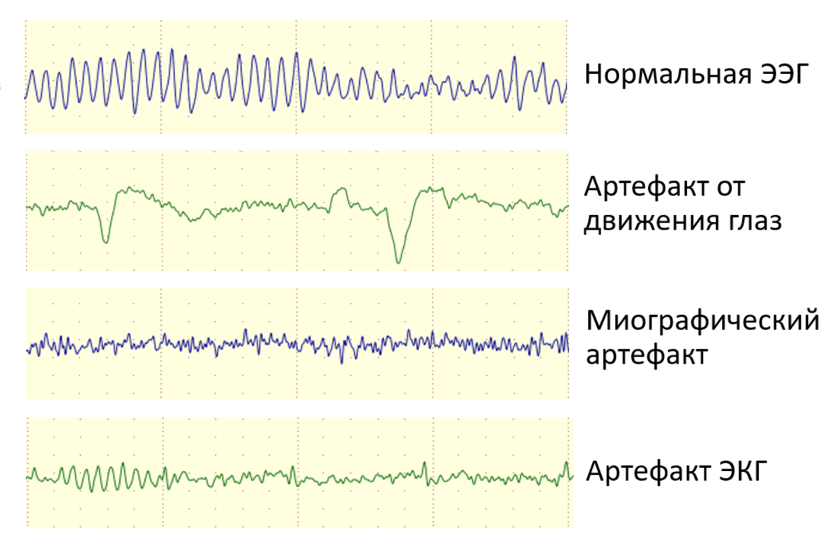 Артефакты на ЭЭГ