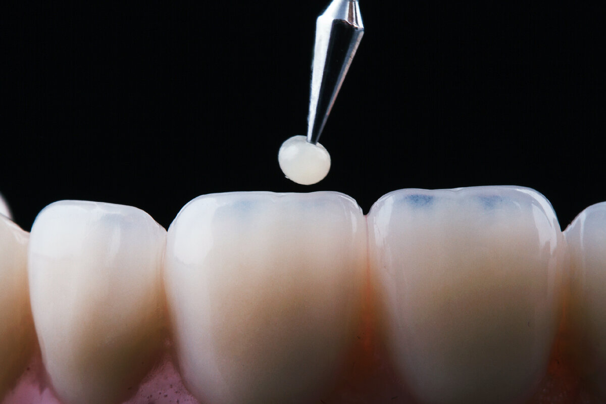Лучше, чем пломба: новый метод восстановления зубов при лечении кариеса ...