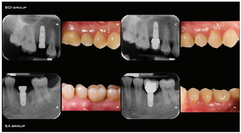 Рис. 2a-2h. a-d: последовательность этапов лечения в группе S01: установка имплантата (а), фиксация протеза через12 недель после имплантации (Ь), прицельная рентгенограмма после фиксации протеза (с), клинический снимок через 4 месяца (d). E-h: последовательность этапов лечения в группе SA: установка имплантата (е), фиксация протеза через 12 недель после имплантации (f), прицельная рентгенограмма после фиксации протеза (g), клинический снимок через4 месяца (h)