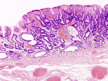  
  Полип ∅6 мм фундальных желёз тела  желудка 46-летней женщины,
 		предположительно также больной ГЭРБ*
            
