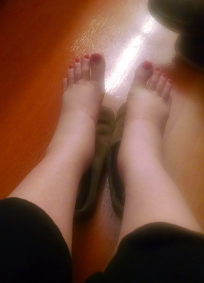 Опухание ног при преэклампсии 