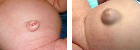 
Пупочная грыжа у младенца