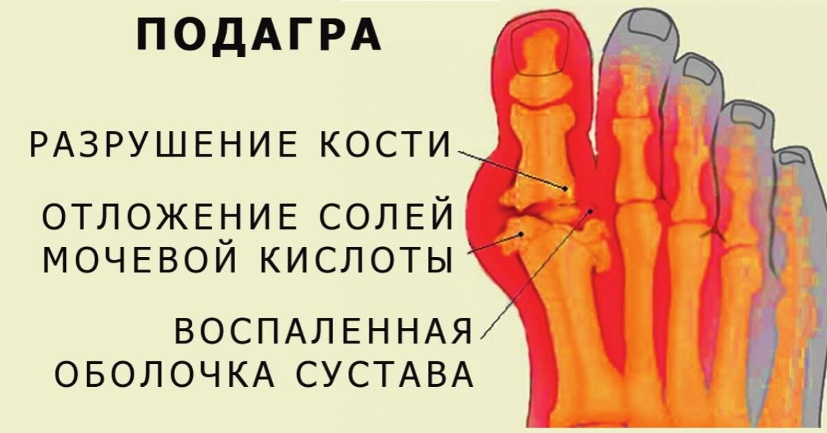 1 Плюсне фаланговый сустав подагра. Подагрический артрит мочевая кислота в. Отложение солей мочевой кислоты в суставах.