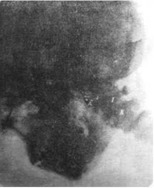 Первый рентгеновский снимок (фотография черепа опубликована в журнале «Медицинское общество Чосон», 1912 г.