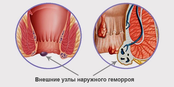 Кровоточивость из прямой кишки - Tartu Ülikooli Kliinikum