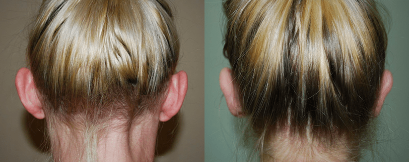 Отопластика. Фото с сайта Д.Р. Гришкяна. Имеются противопоказания, требуется консультация специалиста.