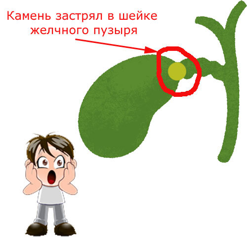 Камень застрял в шейке желчного пузыря