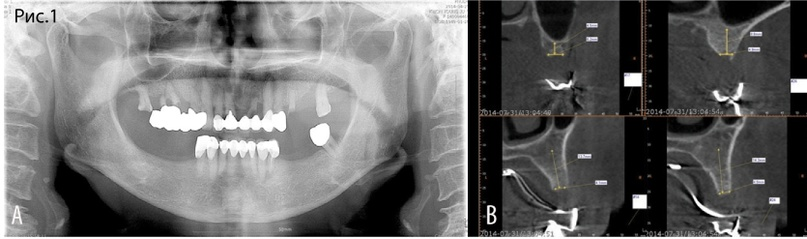 Рис. 1 A. Исходная рентгенологическая картина. Альвеолярная резорбция, пневматизация верхнечелюстных пазух. B. КЛКТ через 2 месяца после удаления зубов