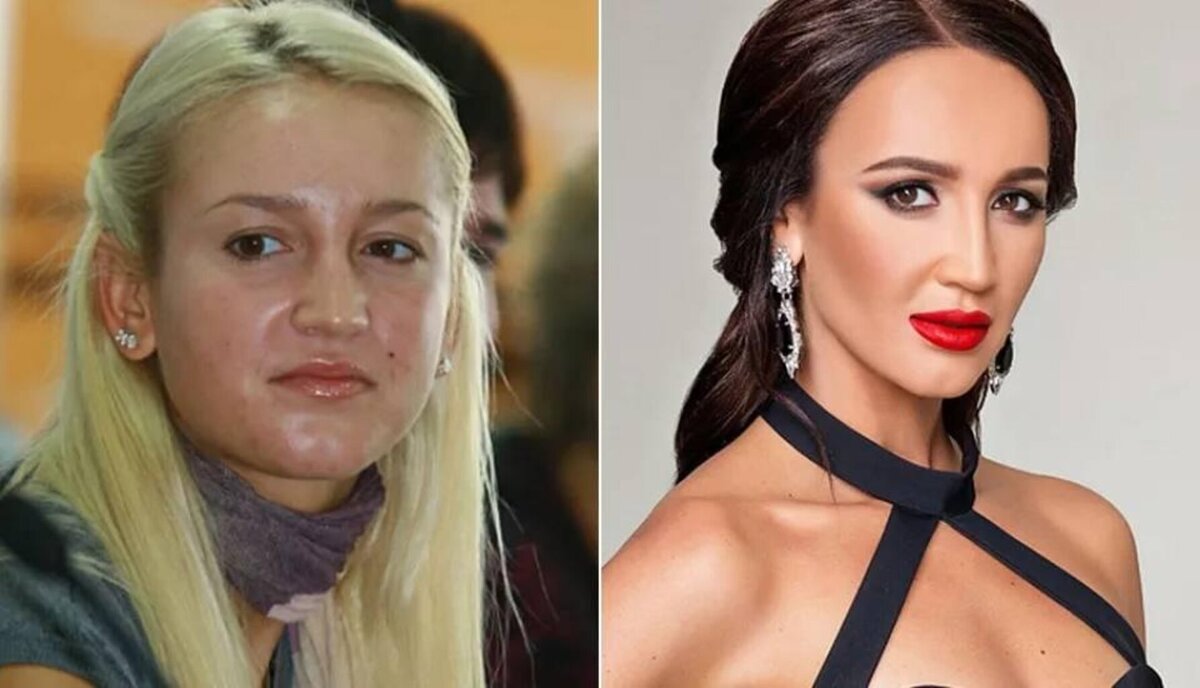 Bad Plastic Surgery Celebrity Before and After Photos Célébrité chirurgie plasti