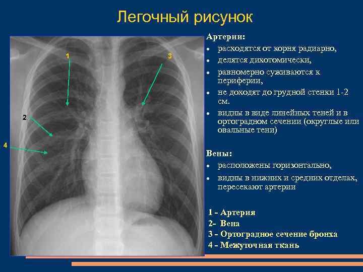 Усилен сосудистый компонент легочного рисунка. Легочный рисунок. Усиление легочного рисунка на рентгене. Легочный рисунок в норме. Усиленный легочный рисунок на рентгене что это.