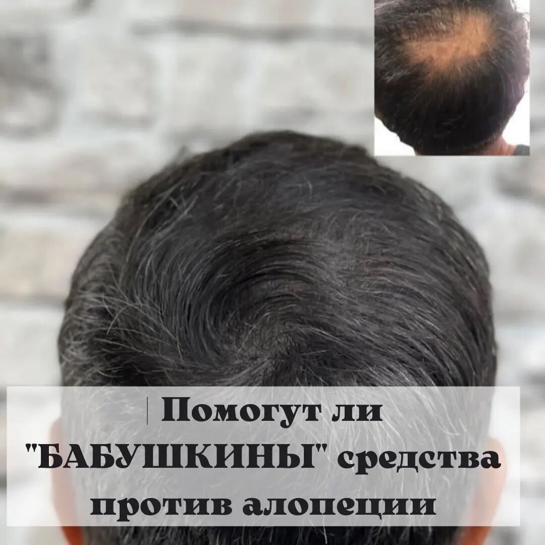 «Бабушкины» рецепты и разрекламированные современные препараты. Нужно понимать, что они могут помочь лишь при выпадении волос, связанном с обратимыми причинами, такими как стресс, болезни и так далее. Снизить ломкость стержней и простимулировать к работе фолликулы вполне решаемая задача. Но это следует делать только после консультации врача в лицензированном медицинском учреждении. Бабушки, соседи, знакомые, собеседники на интернет-форумах за свои рекомендации никакой ответственности не несут! При андрогенной алопеции или травмах, ожогах, когда фолликулов на каком-то участке уже просто нет, никакие лечебные шампуни, маски и препараты по определению помочь не в силах.Здесь выход только один — трансплантация волосяных фолликулов. Не тратьте своё время занимаясь самолечением, незамедлительно обращайтесь к врачам-трихологам. Безопасное и безболезненное восстановление волос - приоритет нашей клиники. Если вы столкнулись с истощением донорской зоны или хотите узнать больше о восстановлении волос - будем рады помочь! __________________________С Уважением и Заботой, "Aymedhair" г.УфаБесплатная онлайн консультация специалиста 📲 8 937 204 31 03