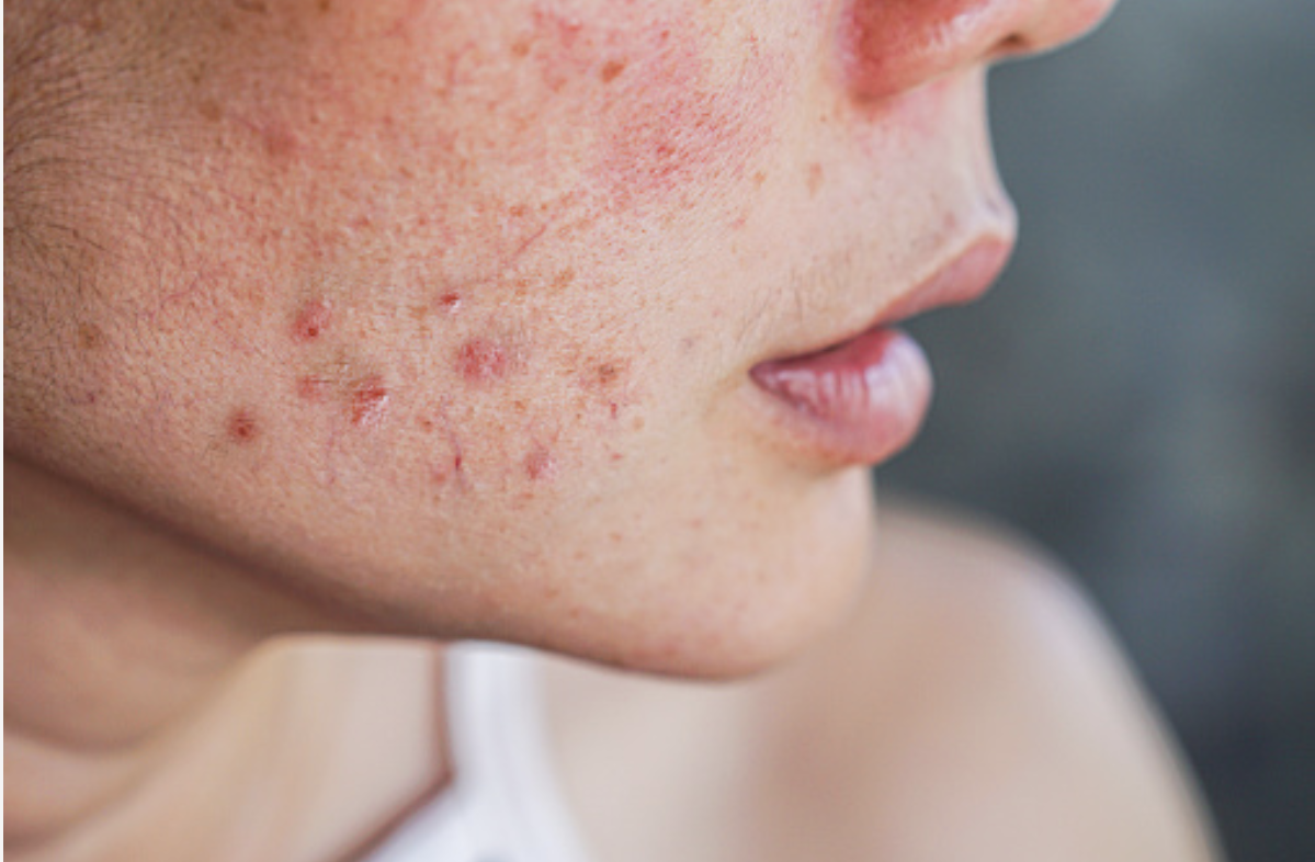лечение акне