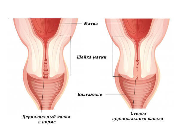 Боли при половом акте