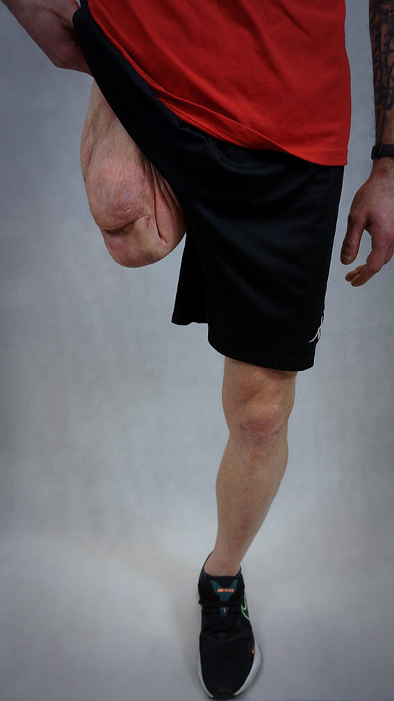 Печать протеза для пациента осложнялось сложной формой культи 