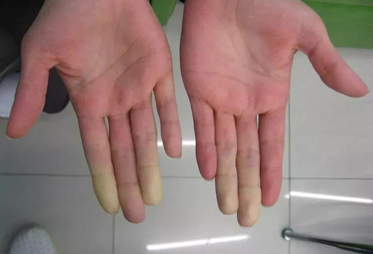 Синдром Рейно