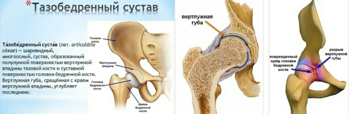 Тазобедренный сустав картинка