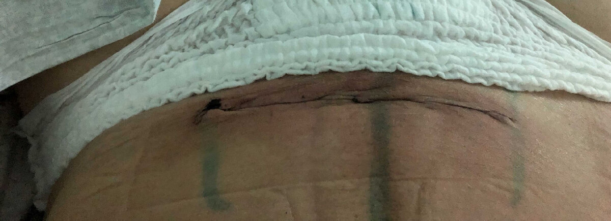 Живот после операции