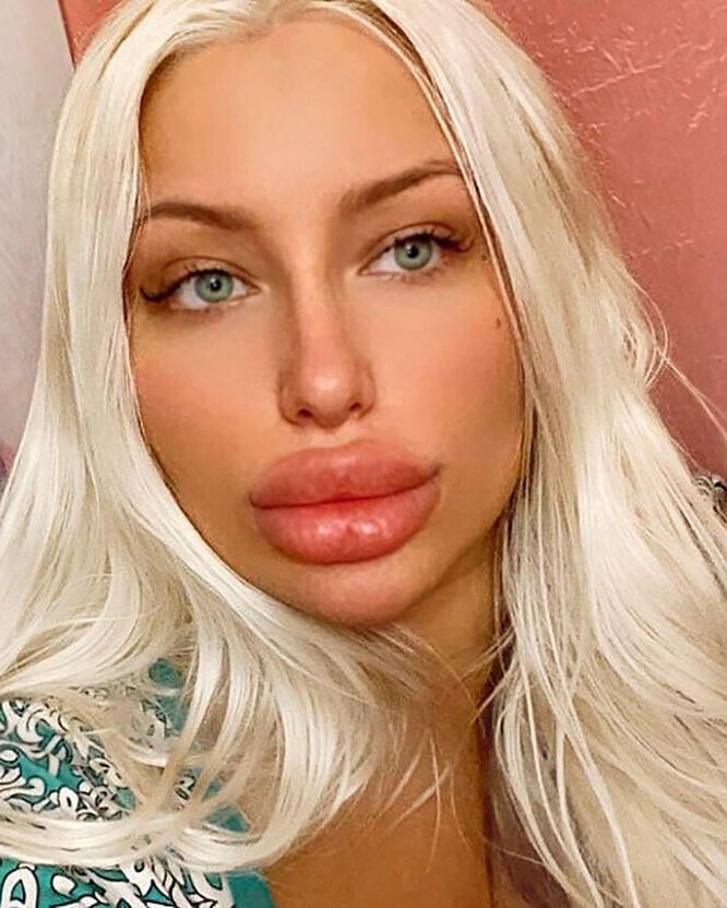 Самые большие губы в мире: 8 девушек, изуродовавших себя филлерами
