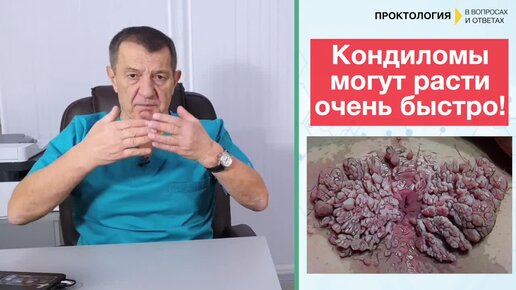 Лечение анальных кондилом и папиллом - клиника Longa Vita