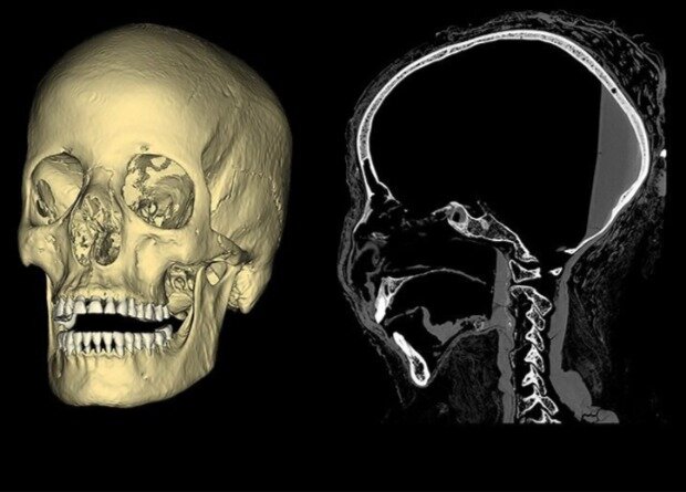 3D-модель черепа и его снимок, созданные с помощью компьютерной томографии. Источник изображения: M. Ozarek-Szilke and S. Szilke / Warsaw Mummy Project