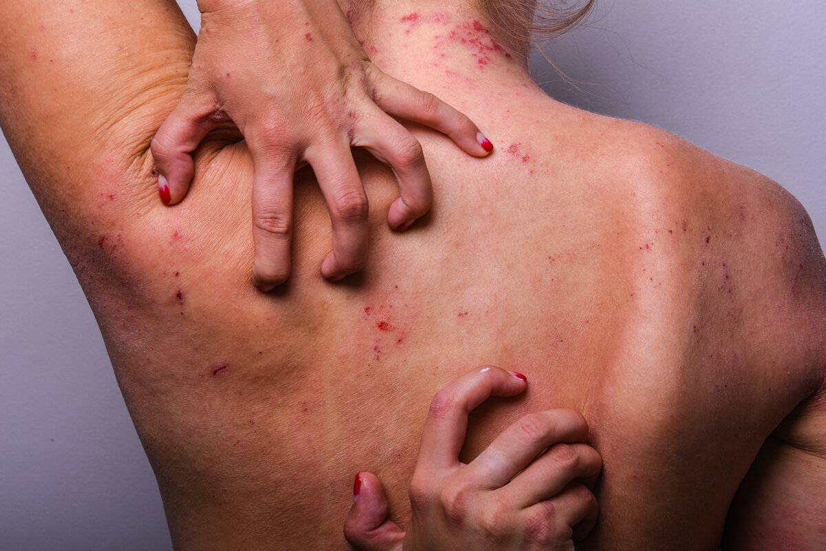 моя кожа с обострением дерматита