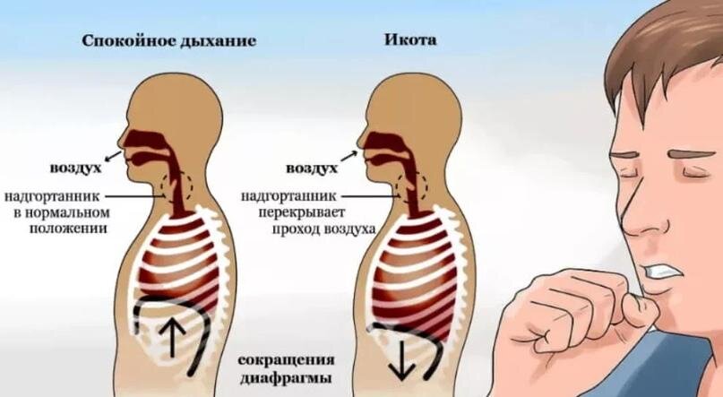 Что значит икота после еды? Причины и способы избавления.