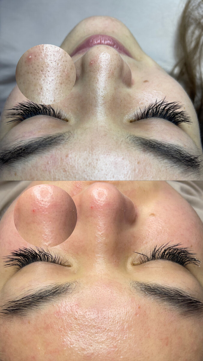 Выполнена комбинированная чистка лица у врача-косметолога Ахмедбековой Дарьи