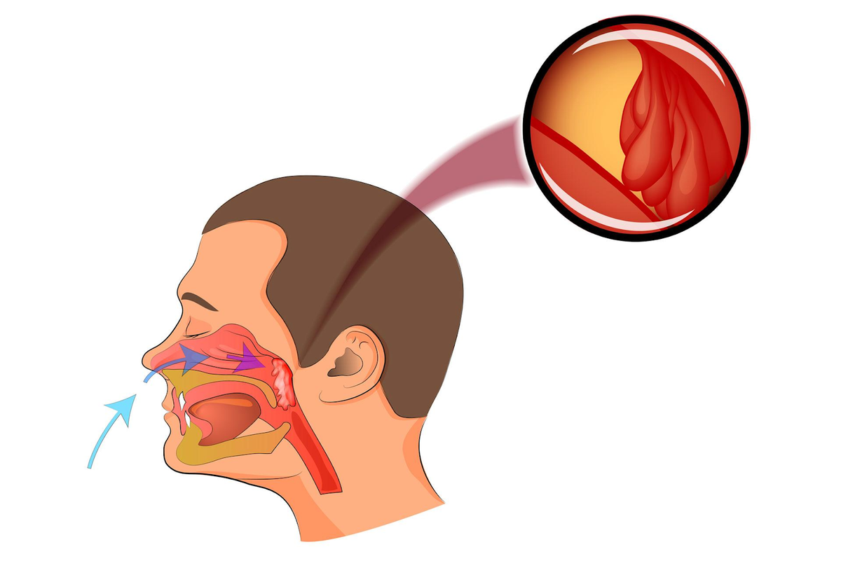 гланды и аденоиды картинки где находятся
