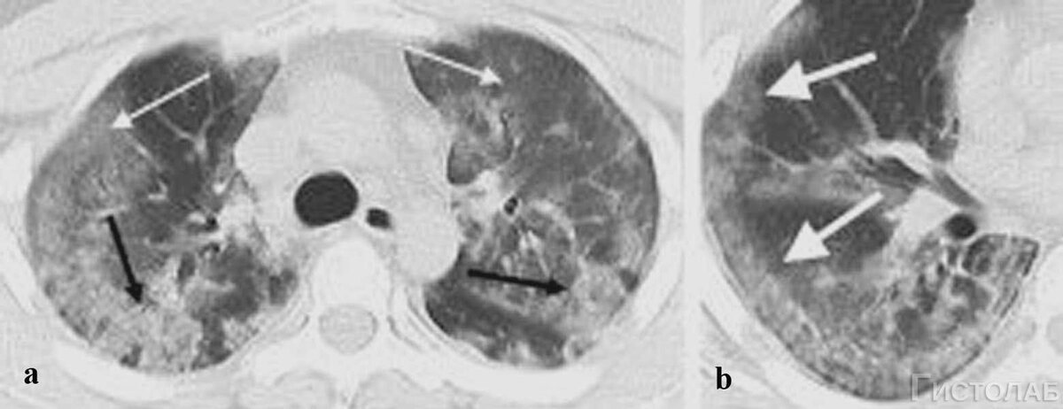 Вирусное поражение легких