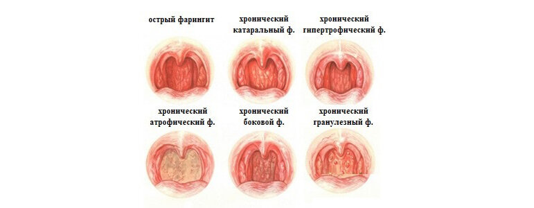 Заболевания горла