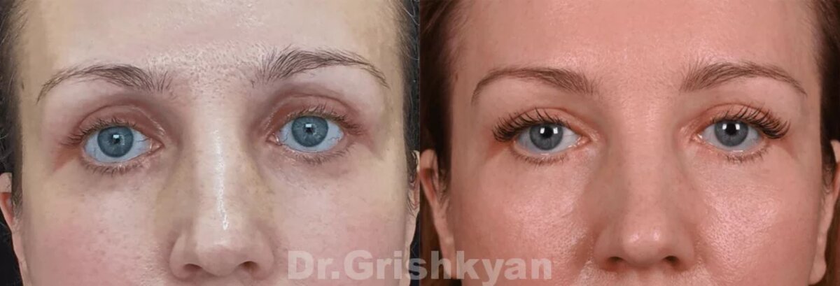 Повторная блефаропластика верхнего века и липофилинг фото до и после. Фото с сайта Д.Р. Гришкяна. Имеются противопоказания, требуется консультация специалиста