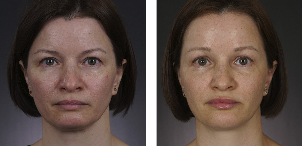 Результат эндоскопической подтяжки лба и бровей и лазерной шлифовки лица. 