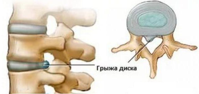 Экструзия диска l2 l3. Фораминальная протрузия диска l4-l5. Протрузия диска l4 l5 что это такое. Парамедианная экструзия диска l5-s1 что это. Экструзия межпозвоночного диска l5-s1.