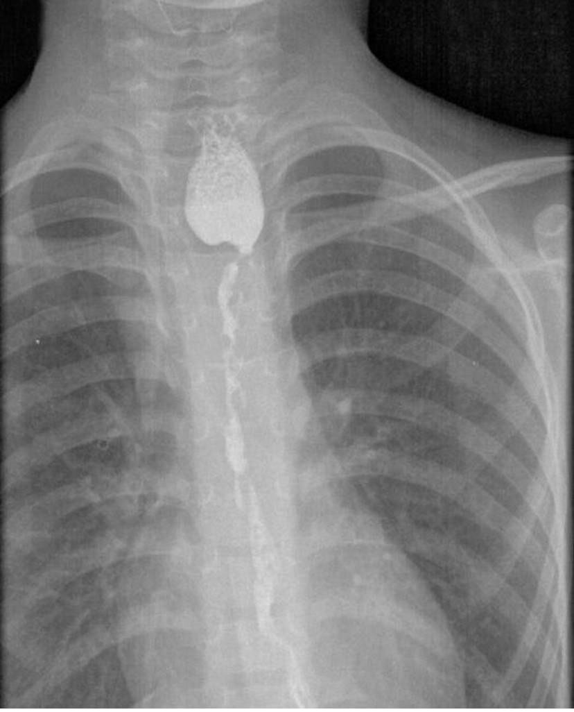    Искусственный пищевод Фото: Правительство Иркутской области