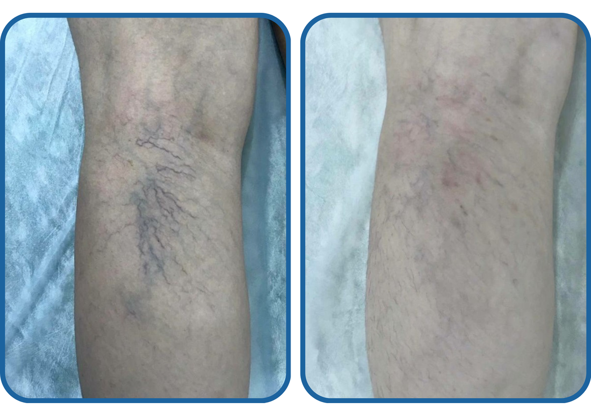 До/После склеротерапии. Процедура проводилась специалистами клиники ДАВИНЧИ. 