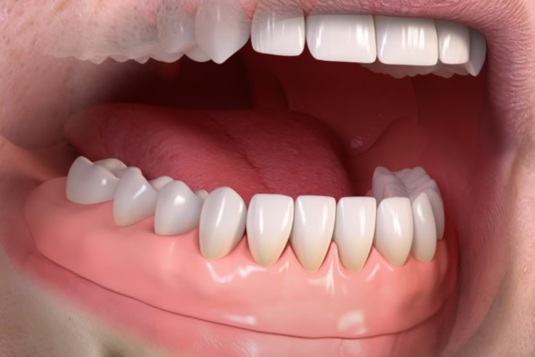 Полный съемный протез на нижнюю челюсть