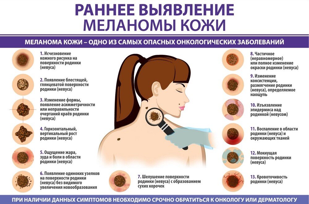 Предупреждающие знаки и изображения меланомы - Фонд рака кожи