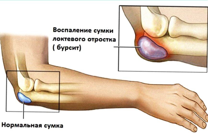 Лечение бурсита суставов ног