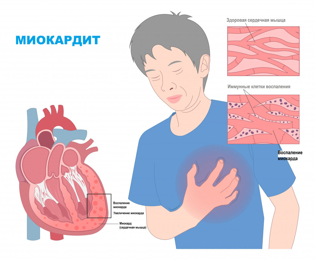 Одна из самых серьезных и труднодиагностируемых в кардиологии болезней... |  кардиолог д.м.н. профессор Виталий Зафираки | Дзен