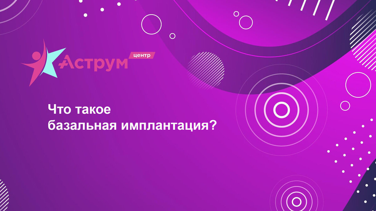 Посмотрев это видео вы узнаете:   что такое базальная имплантация? В чем преимущества базальной имплантации? Где можно сделать базальную имплантацию? 
