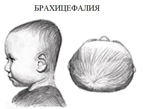 Синдром плоской головы. Плагиоцефалия и брахицефалия - Центр детского сна и развития BabySleep