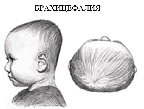 Опухоль головного мозга - симптомы, причины, признаки и методы лечения у взрослых в «СМ-Клиника»