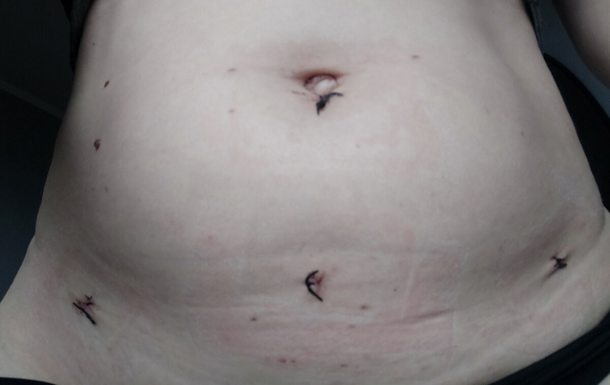 Живот на 7 день после лапароскопии 