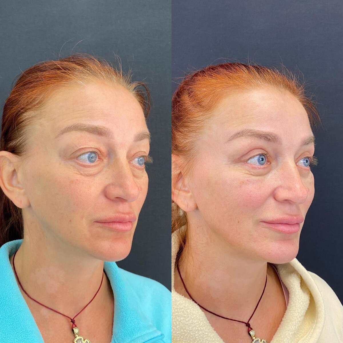 Работа пластического хирурга клиники Медист Союмбека Мирзабекова