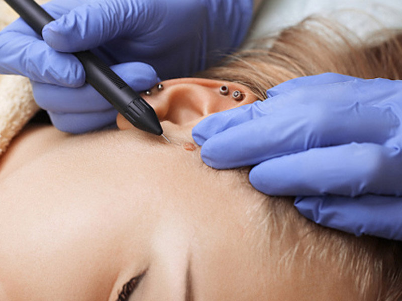 Удаление новообразований. Радиоволны бородавки. Радиоволны бородавки. Аппарат радиоволновой хирургии сургитрон. Радиоволновой аппарат сургитрон.