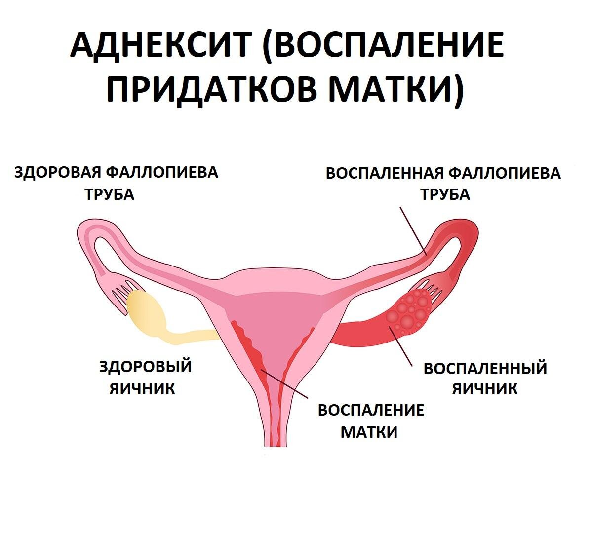 Картинка матка с придатками